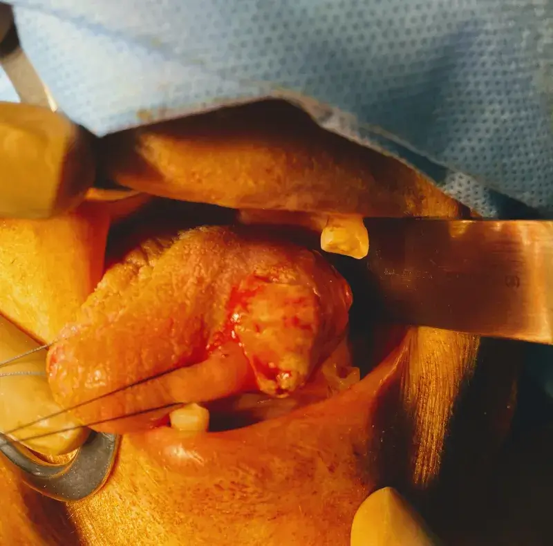 tongue_cancer_treatment_cost_in_ahmedabad