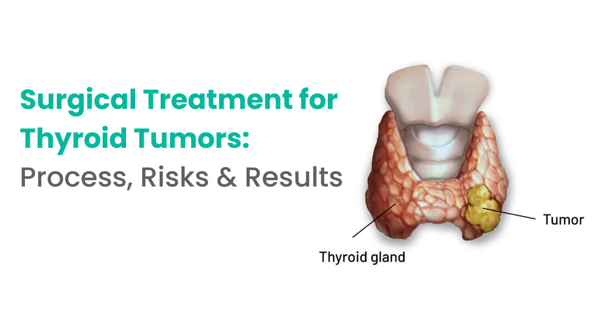 Surgical Treatment for Thyroid Tumors: Process, Risks & Results