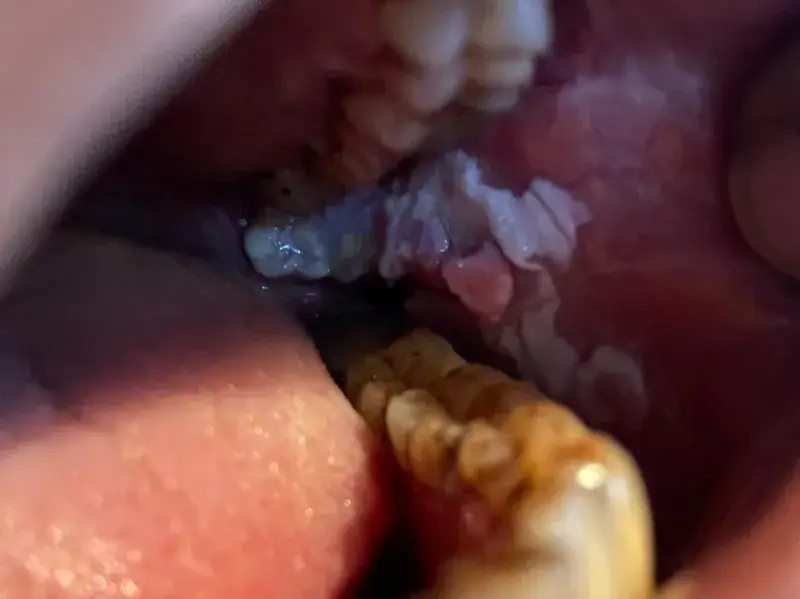Oral Cancer Surgery In Ahmedabad oral_cancer_surgery_in_ahmedabad