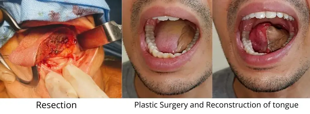 Tongue Cancer Treatment In Ahmedabad tongue_cancer_treatment_in_ahmedabad
